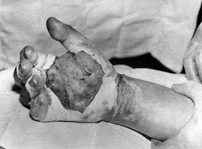 Harry K. Daghlian’s blistered and burnt hand Image